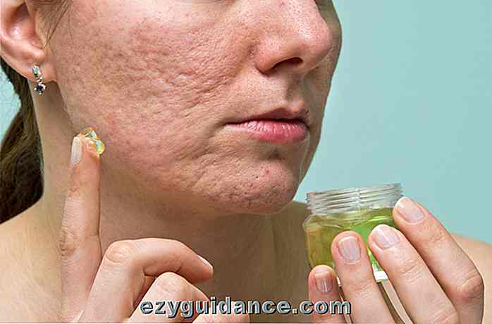 10 effektivste Möglichkeiten, Akne-Narben und Pickel-Markierungen zu entfernen