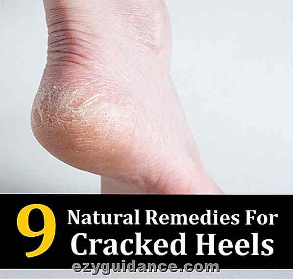 9 natürliche Heilmittel für Cracked Heels