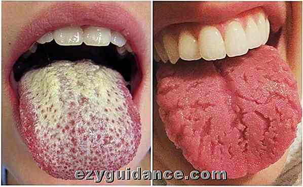 12 Warnzeichen, die Ihre Zunge über Ihre Gesundheit senden könnte