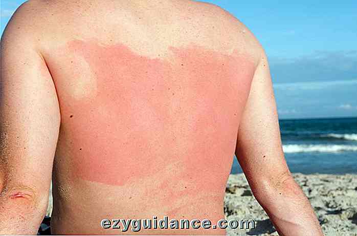9 remedios caseros más eficaces para sanar una quemadura de sol rápidamente